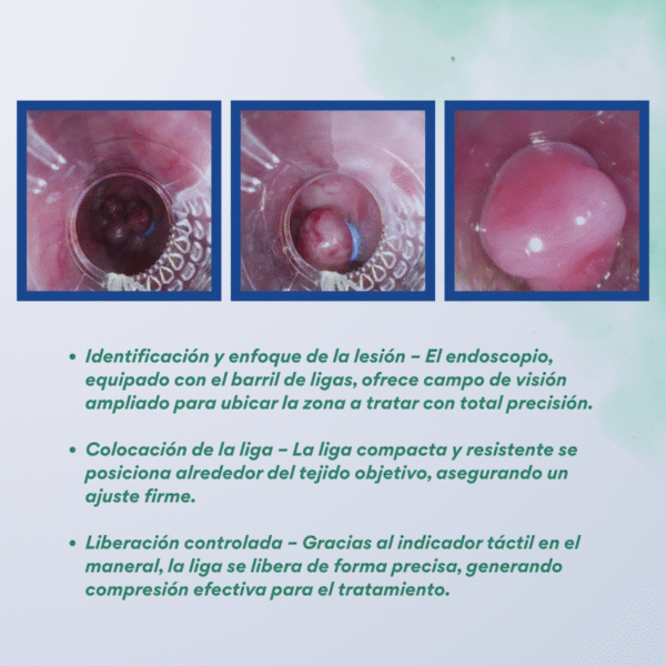 Barril de ligas esofágicas - Image 5
