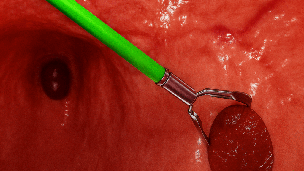 Hemoclips vs otras técnicas hemostáticas: