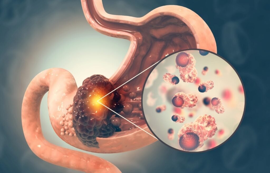 Indicaciones de disección submucosa endoscópica
