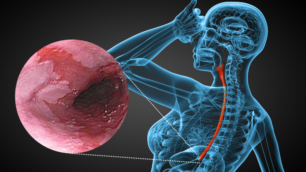 ablación por radiofrecuencia en esófago de Barrett durante endoscopia
