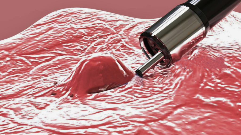 electrocoagulación endoscópica en hemorragia digestiva