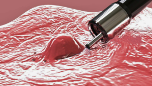 electrocoagulación endoscópica en hemorragia digestiva