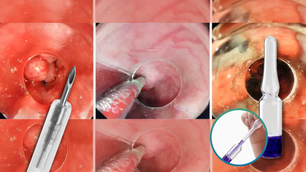 Esclerosis endoscópica