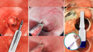 Esclerosis endoscópica