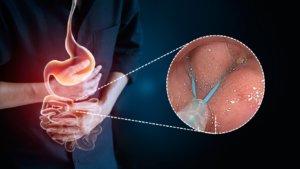 Endoloop prevención de hemorragia en polipectomía