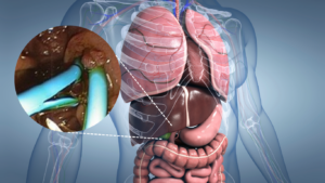 Protocolos para el seguimiento de una prótesis biliar