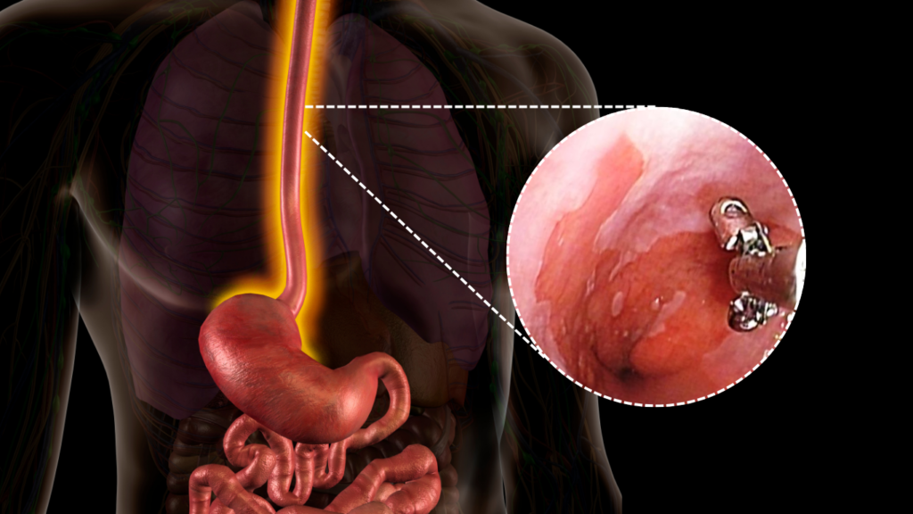 Técnica correcta de biopsia