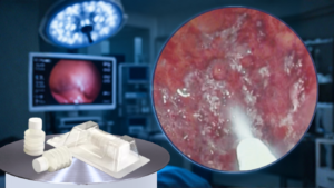 Polvo hemostático en endoscopia: descubre cómo esta innovación controla el sangrado digestivo complejo cuando las técnicas convencionales fallan.