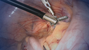 Tijeras flexibles en endoscopia